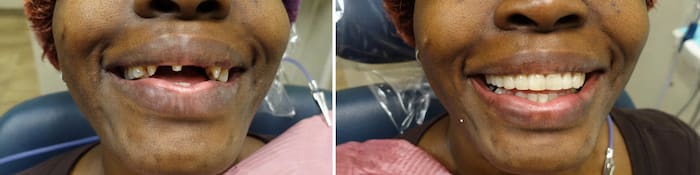 Результат стоматологического лечения до и после в Hollywood Smile NY