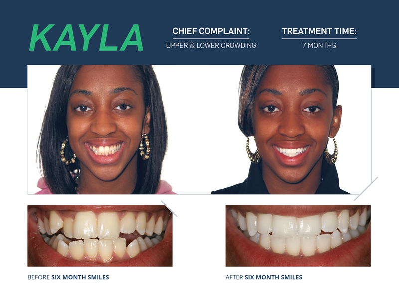 Six Month Smiles — before and after